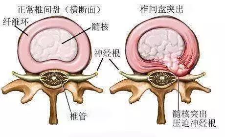 腰椎间盘突出最新治疗方法：腰椎间盘突出症新疗法揭晓